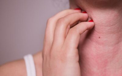 Alergia la nichel