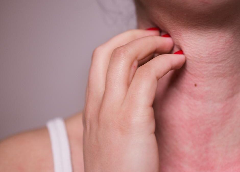 Alergia la nichel