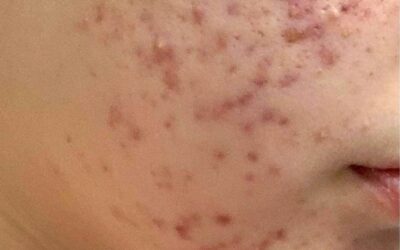 Acneea – Ce este, cauze, simptome, factori de risc, tratament